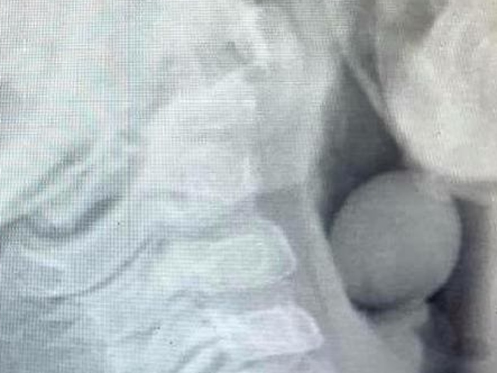 Terrifying x-ray shows the risk of toddlers choking on grapes. Picture: Facebook.