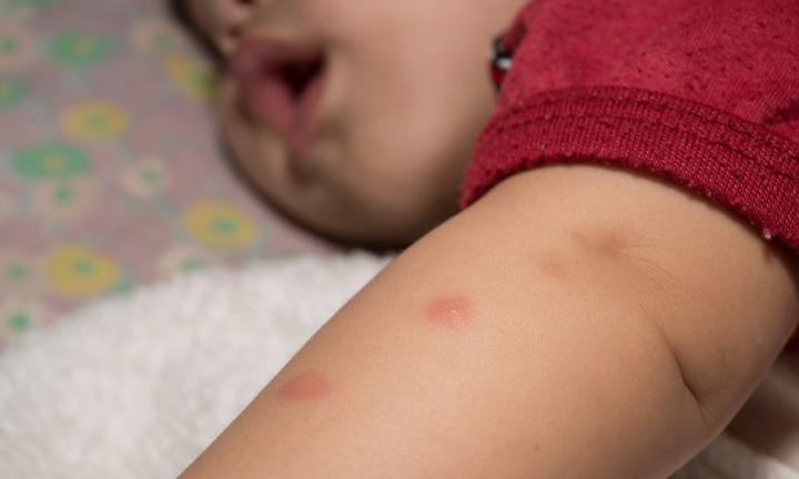 Is Your Child Allergic To Mosquitoes Dr Sam Hay Kidspot