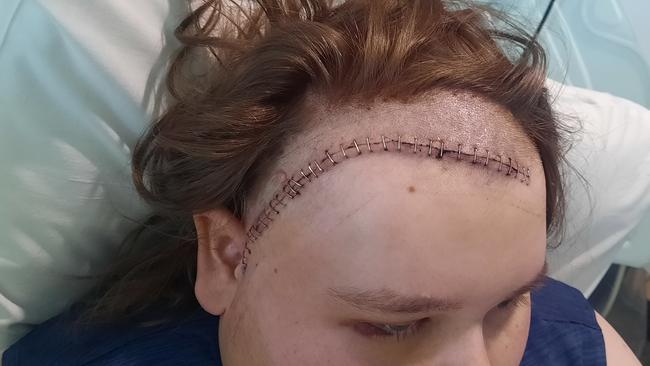 Beau Evans underwent a seven hour surgery on the right side of his brain. Picture: Supplied