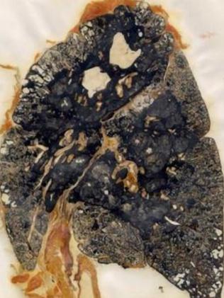 Specimen of lung with Progressive Massive Fibrosis, a later stage of CWP.