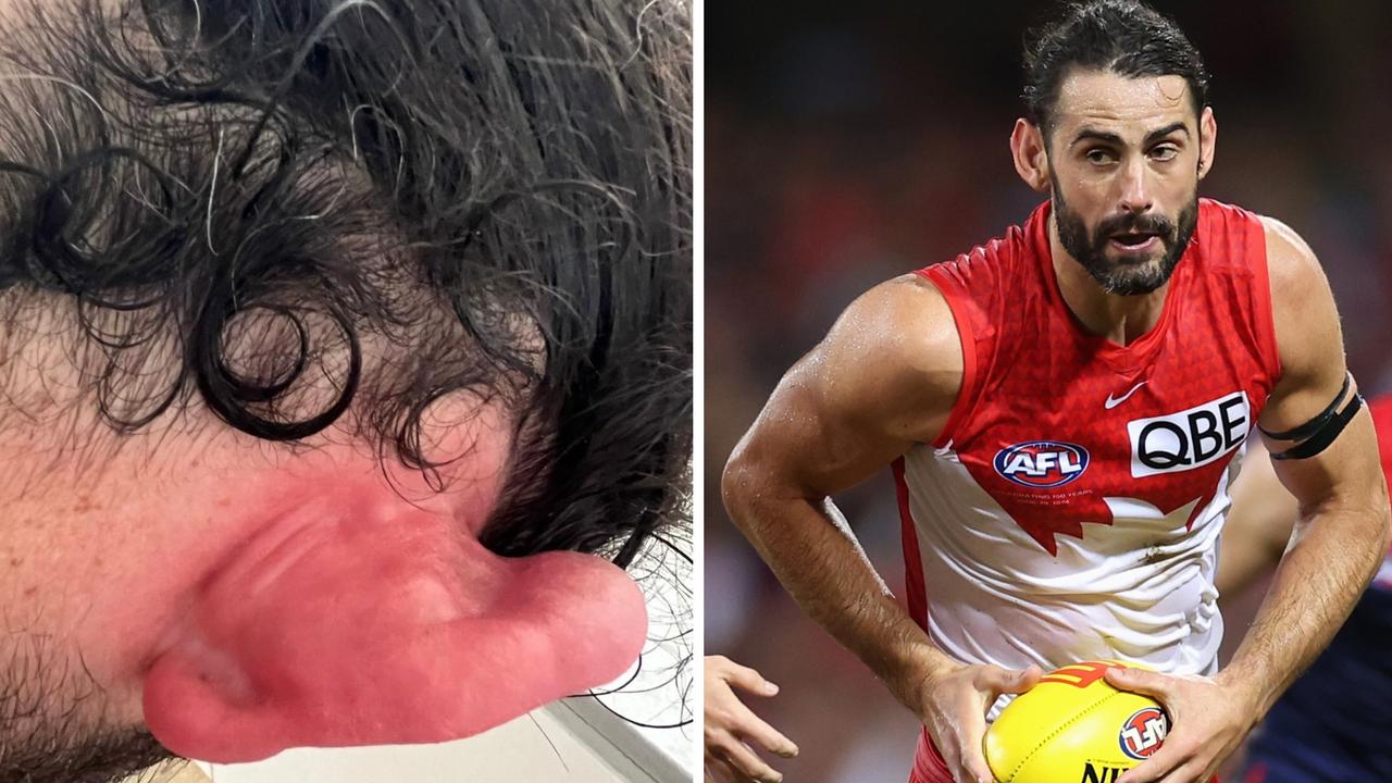 AFL 2024 Brodie Grundy stung by bluebottle jellyfish before Swans