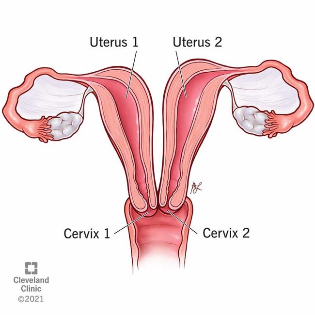 Patients with uterine didelphys have two uteruses. Some also have two cervixes and vaginas. Picture: Cleveland Clinic.