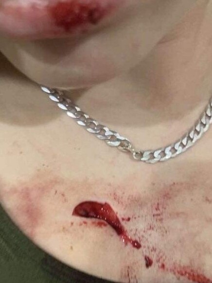 The mother of one of the victims of the alleged Smithfield stabbing shared images of injuries with local MP Craig Crawford at a private meeting last week. Picture: Supplied.