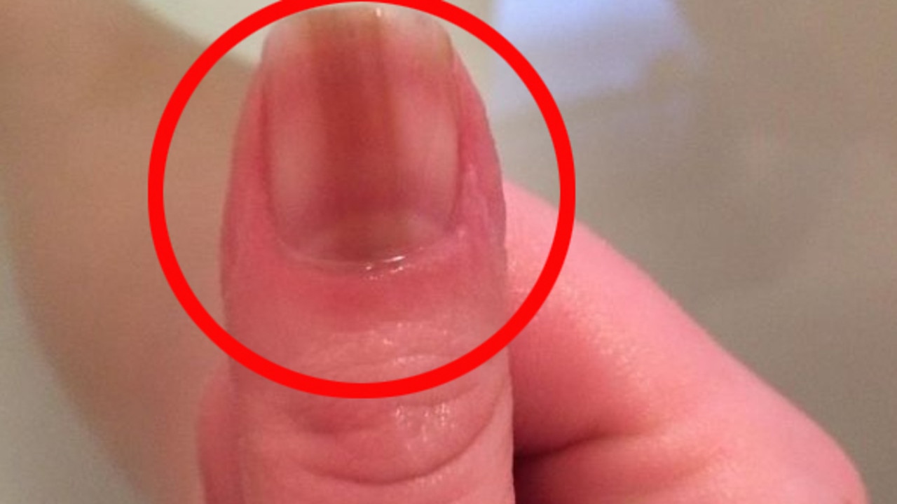 Mark on woman's fingernail was melanoma cancer  — Australia's  leading news site
