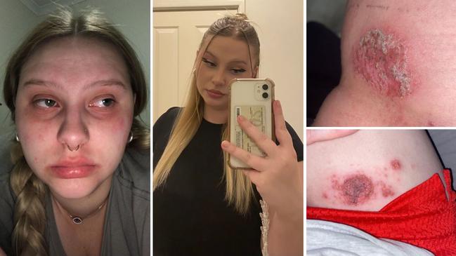 Leilah Johnson had to quit her job after a debilitating skin condition flared in the recent cold snap.