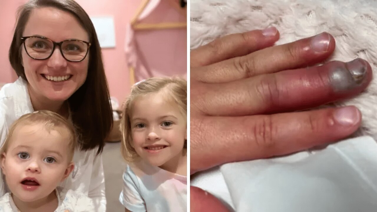 Abigail's finger was swollen and hot to the touch. Source: Yahoo Australia