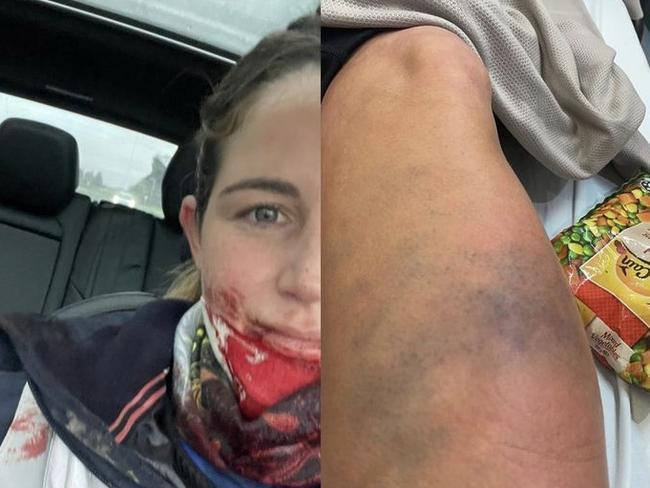 Michelle Payne posted a picture of her injuries on Instagram. Picture: Supplied