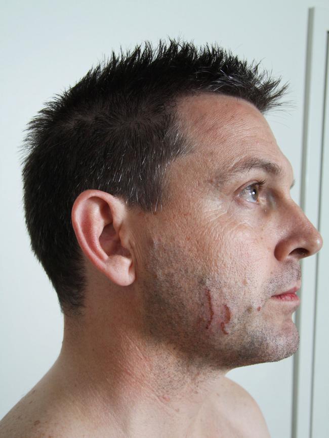 Police photographs of marks on Gerard Baden-Clay's skin used as evidence in court.