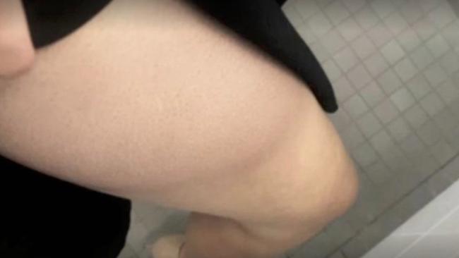 A photograph provided by Ms Higgins to The Project of a bruise she claims she sustained during her alleged sexual assault. Picture: Seven News Spotlight