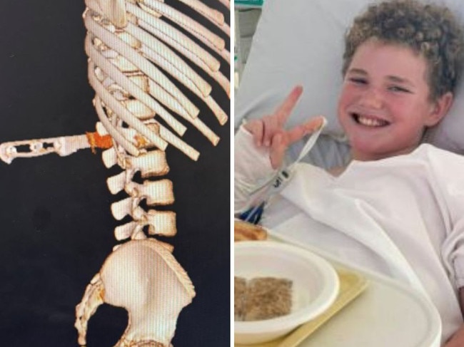 Boy’s lucky escape after falling on steak knife. Picture: Supplied