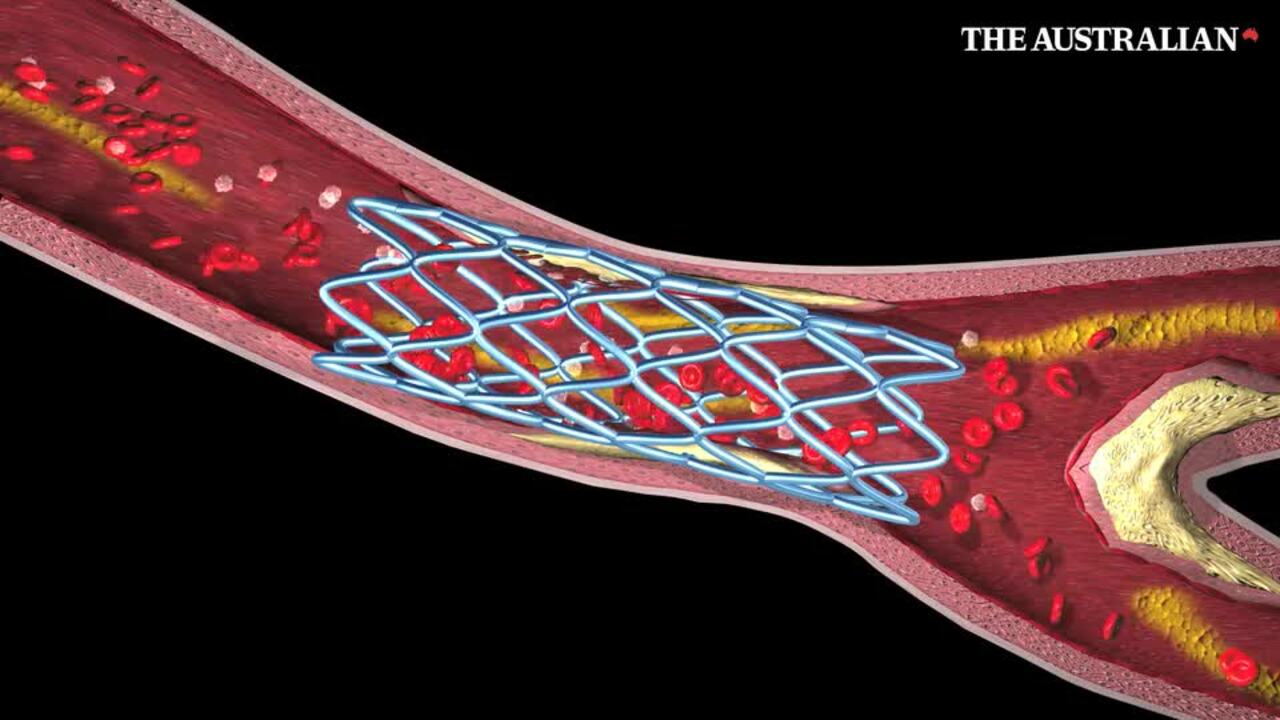 How a stent works