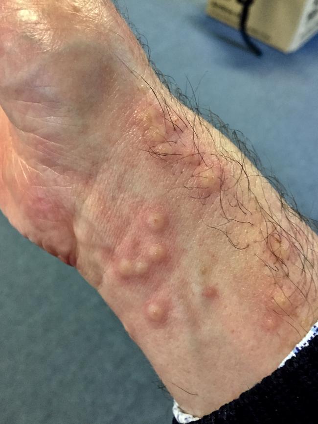 The results of jimble jellyfish stings on the wrist of Balmoral swimmer David Sanney. He said the welts appear a few days after the sting. Picture: Supplied