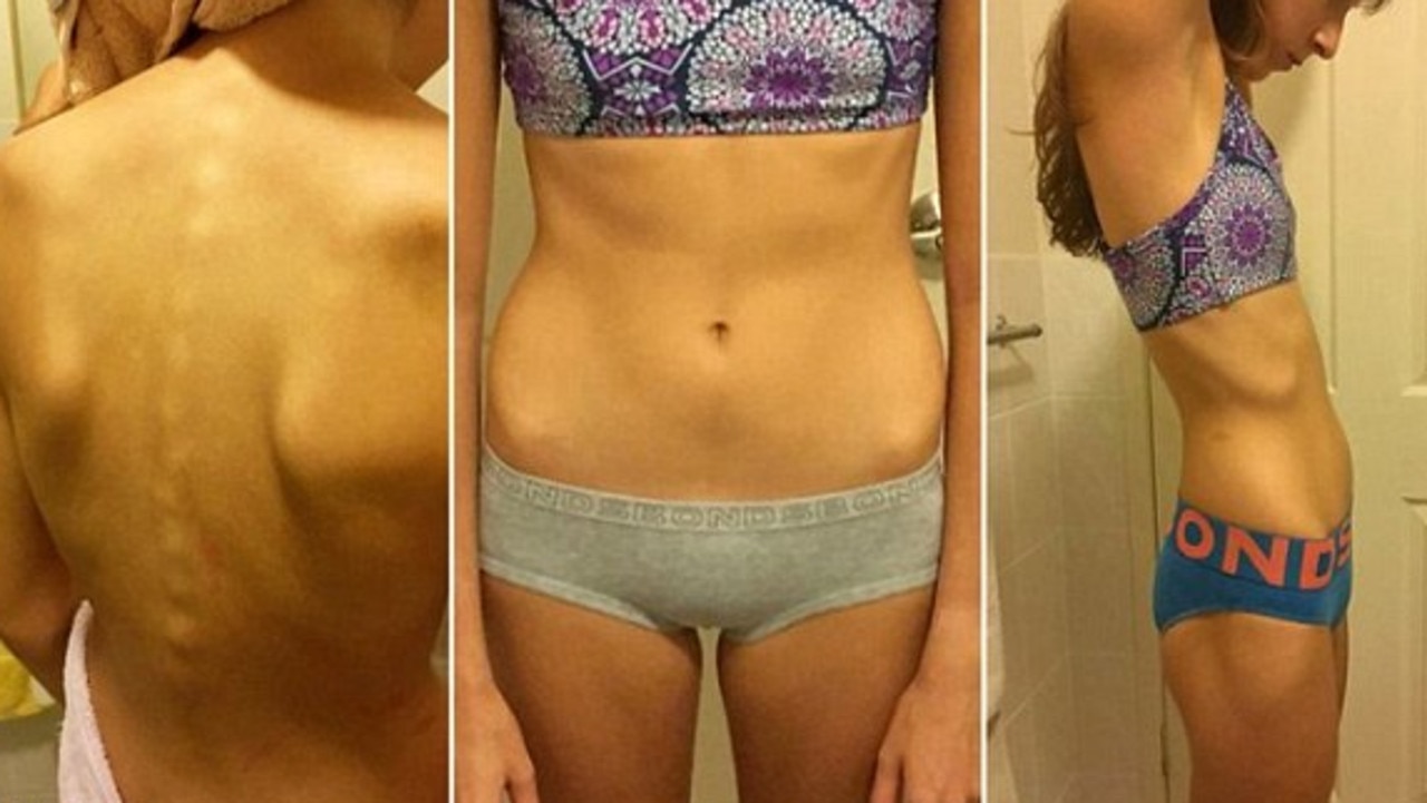 Bullied teen reveals new bikini body after suffering from anorexia - NZ  Herald