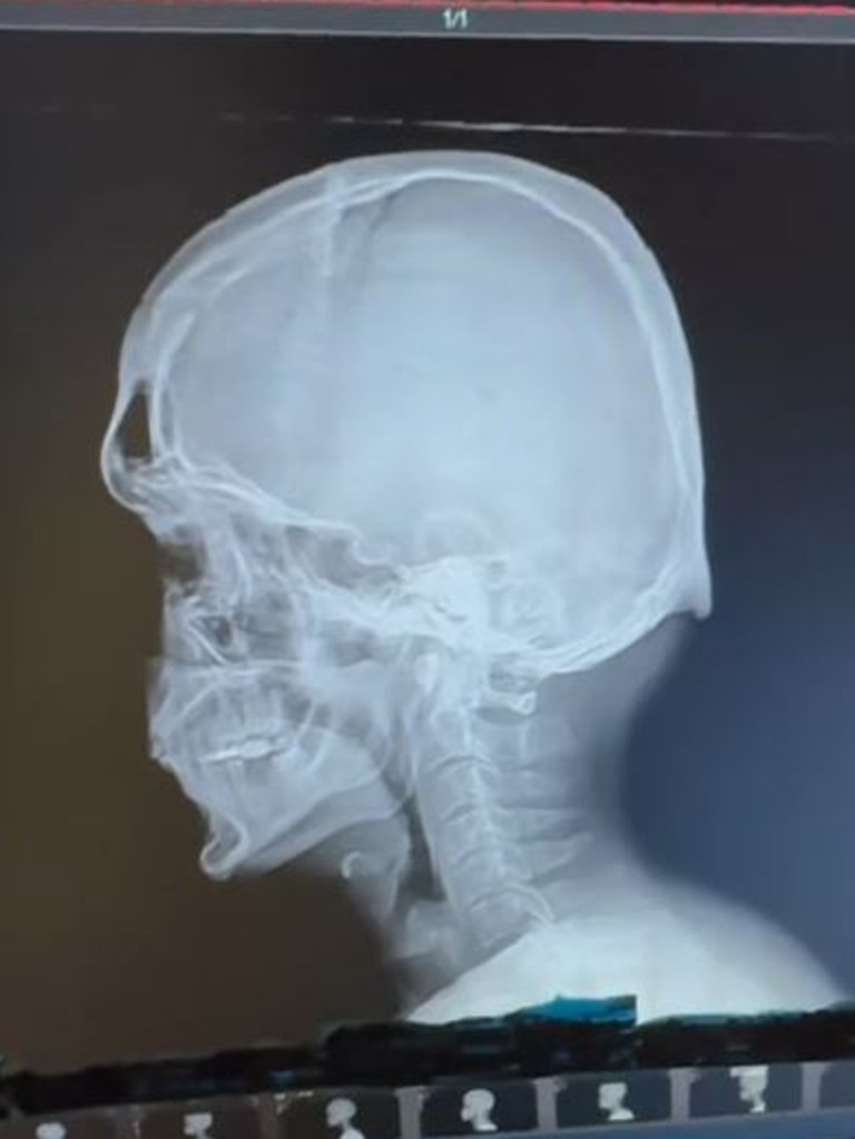 In some cases, patients can develop a ‘horn’ on the back of their skull. Picture: @desmoineschiro/TikTok