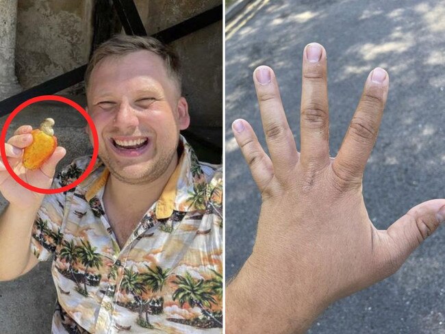 The man received painful burns from the fruit