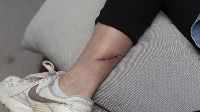 The surgical scar on Renee Garing's leg is healing after she had a skin cancer removed earlier this month. Picture: Alan Barber