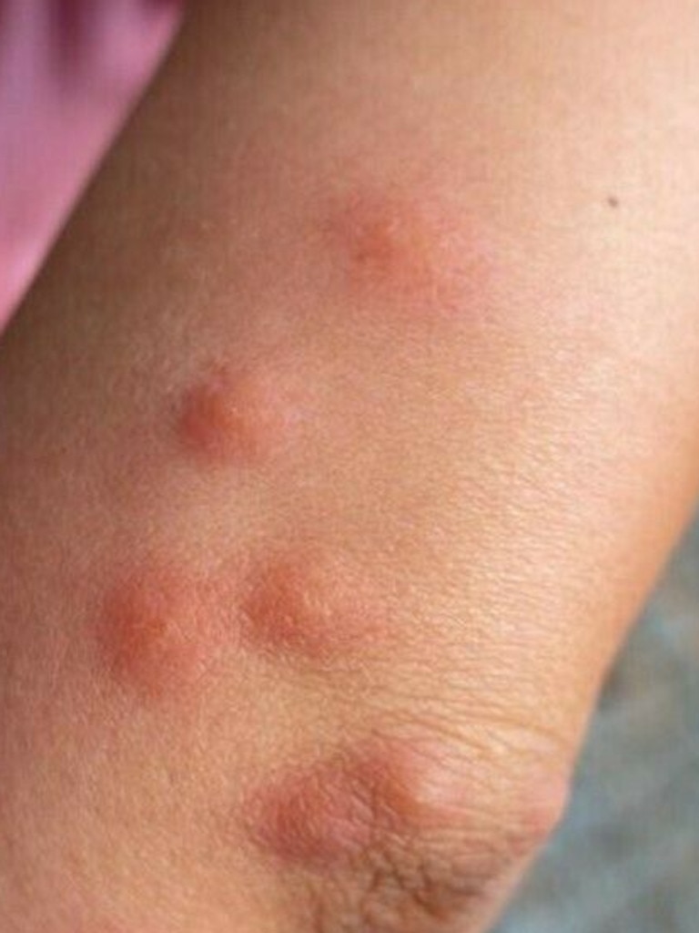 The first sign of infection is usually a small, painless lump. Picture: Altmeyers Medical Encyclopedia