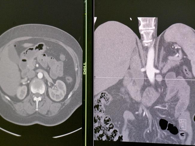 In a transplant first, 12 surgeries are taking place across Melbourne in a chain of kidney transplants. The process underway at the Royal Melbourne Hospital. Scans on the wall in the Theatre. Picture: Jay Town