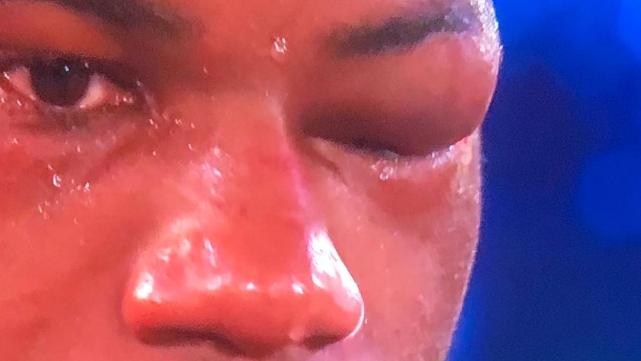 Daniel Dubois' injured eye socket.