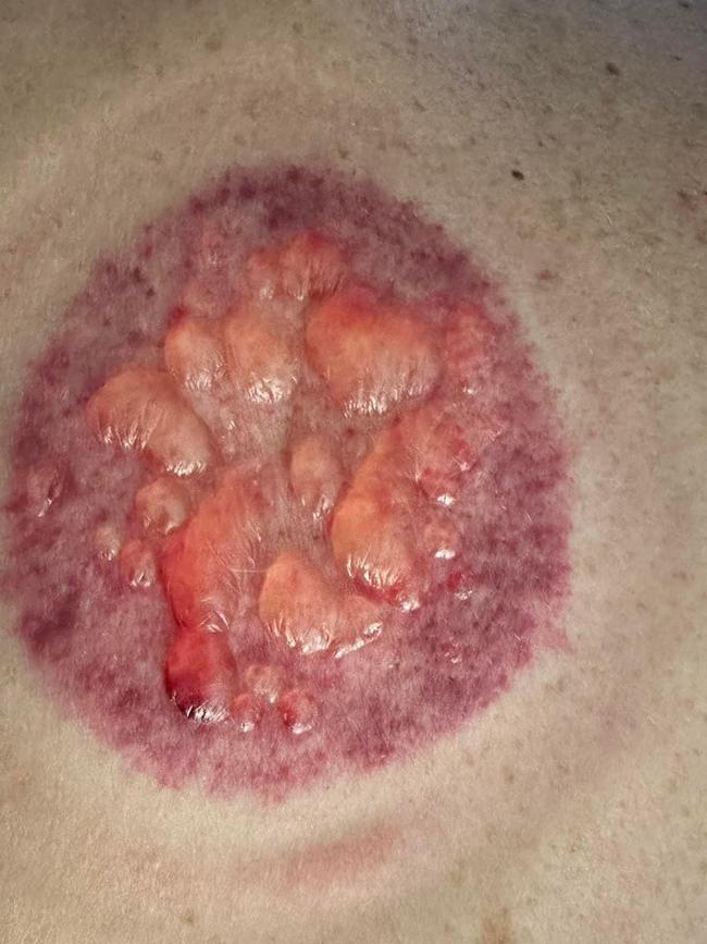 Pictures of blisters on a woman’s back after a cupping treatment. Picture – Facebook.