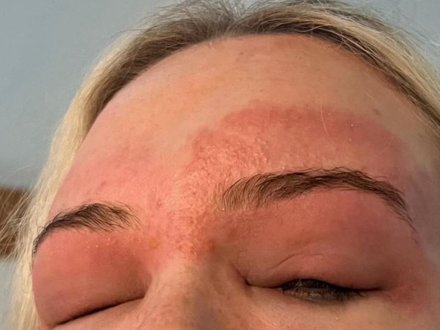 She had an allergic reaction after getting her eyebrows waved. Picture: TikTok/@the.kind.duo