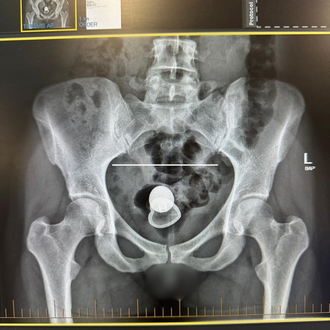 An adult toy got stuck in her rectum, resulting in surgery. Picture: Supplied