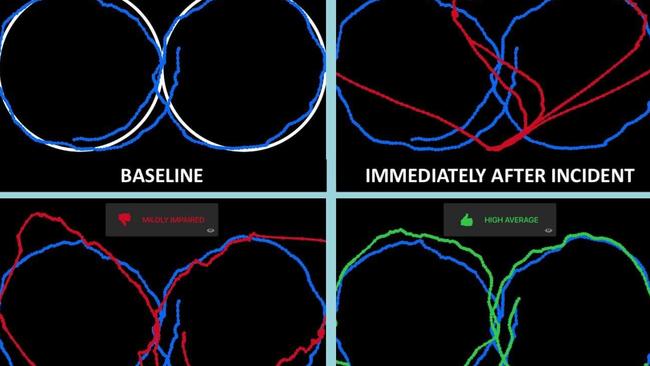 Graphs showing eye movement following a figure eight: clockwise from the top left: base; immediately after incident; one week after the incident; two weeks after the incident.