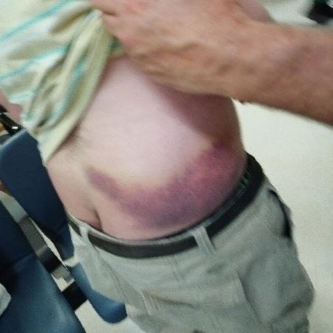 Daniel, now 40, was found with large bruises so severe he underwent a scan to check for internal bleeding. Picture: Supplied by Karen Rogers/Royal Commission