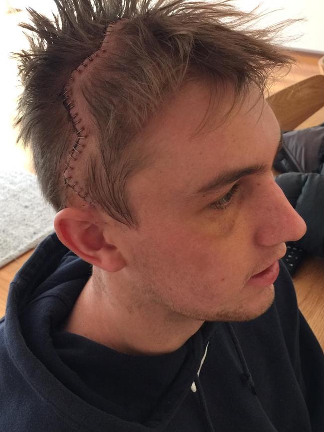 Liam Mahoney reveals his stitches after the attack.