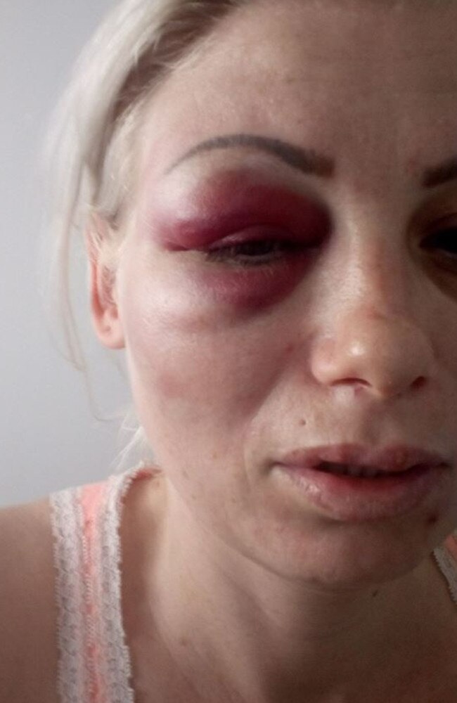 Stacey Gleeson after she was assaulted. Picture: Facebook