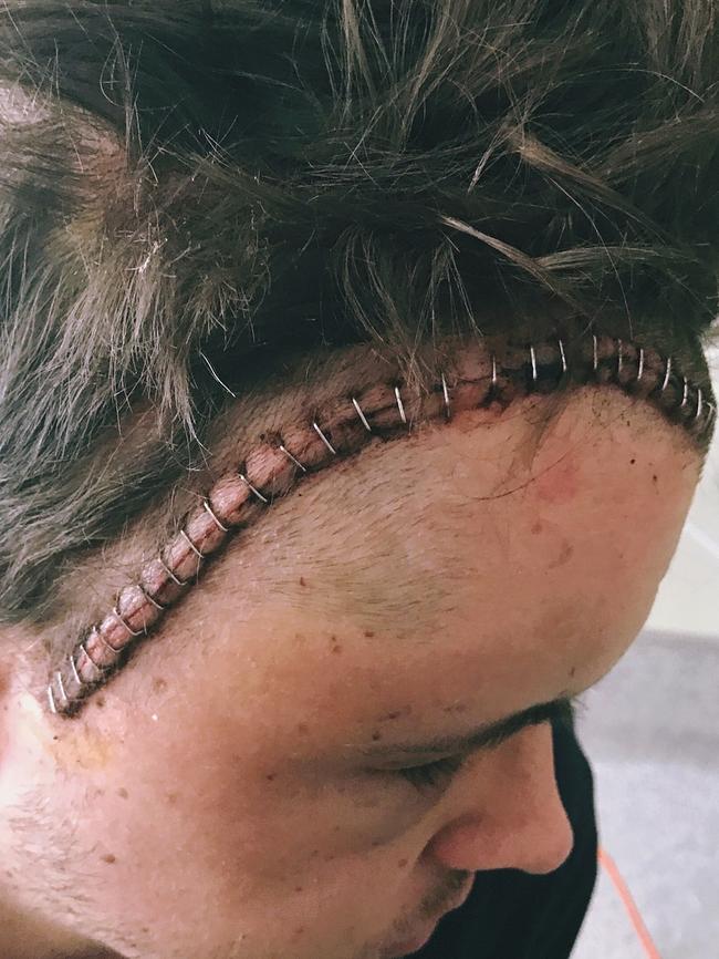 Johnny Ruffo’s large scar after the operation. Picture: Instagram