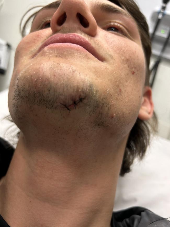 Osborne got stitches after going to hospital. Picture: Supplied