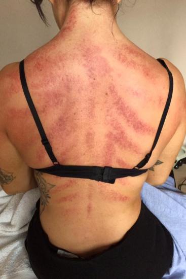 Hairdresser's photo shows bruised back and the physical toll of