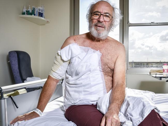 The state's burns unit has seen a record number of patients for scalds (mainly older people in the shower) and home DIY accidents. The burns unit is full. Greg Crowder recovers in the burns ward at the Alfred Hospital after he accidentally set himself on fire while using an angle grinder. Picture: Jake Nowakowski.