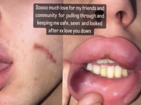 Transgender women Quinn and Chyna suffered cuts on their face and a bruised lip . Picture: Supplied