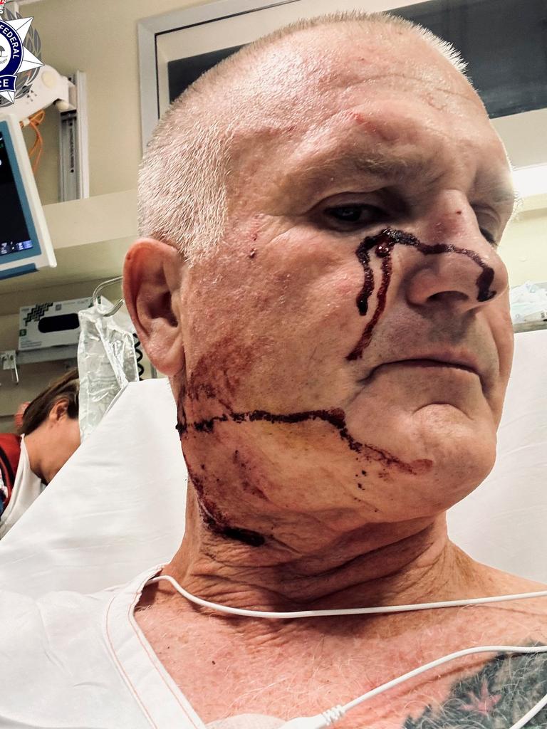 An AFP officer needed hospital treatment after being stabbed in the face and neck with a pen while making an arrest off a Jetstar flight. Picture: Australian Federal Police