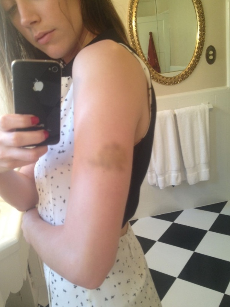 Heard also shared a picture of herself sporting a large bruise on her arm.