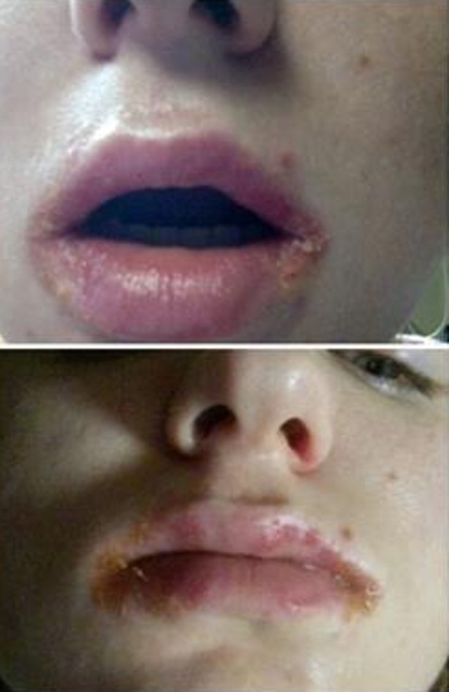 “This is week 3 of painful lips ... and mouth,” wrote this woman on the eos Facebook page.