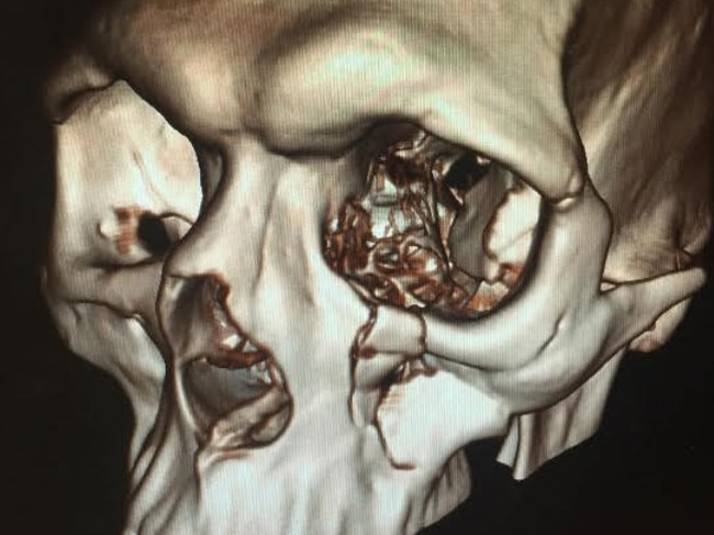 The image of Sam Thaiday’s fractured cheekbone uploaded to Instagram by Thaiday’s wife Rachel.