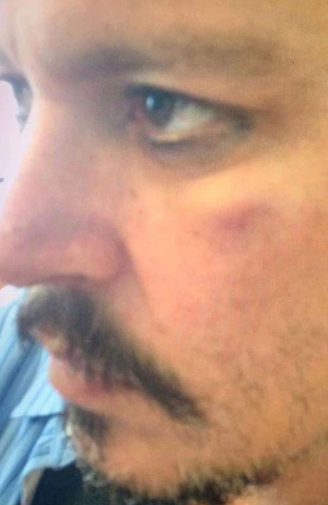A picture of Johnny Depp’s bruise shown in court.