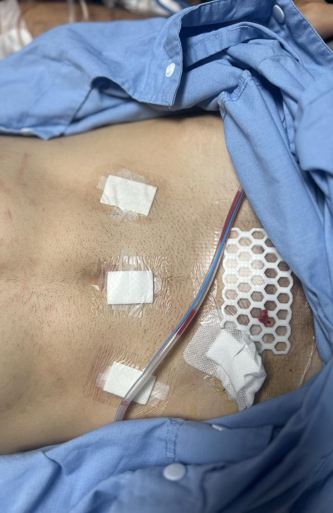 Picture of Todd McManus’ stomach after surgery.