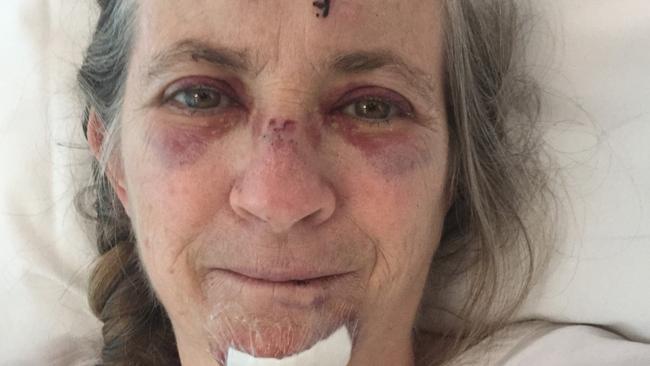 Jennifer Goard was left with shocking injuries after a car hit her motorbike at Mentone in 2019. Picture: Supplied