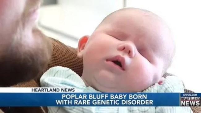 Their baby was born with a rare genetic condition that affects less than 30 people worldwide. Picture: KFS-TV