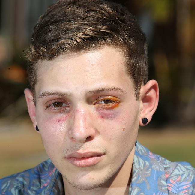 Joshua and his 16 year old brother claim they were the victims of a brutal gay bashing on the Gold Coast at Coomera. Picture Glenn Hampson