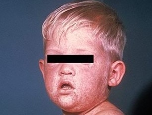 A typical measles rash. Picture: Victoria Department of Health