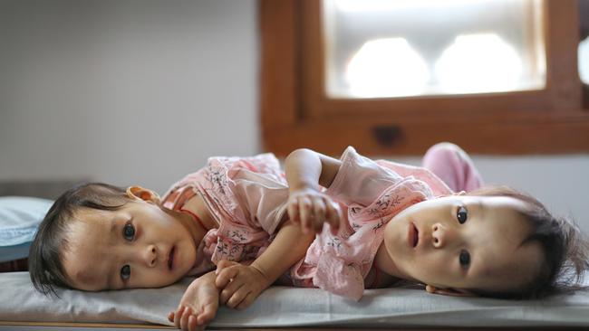 The girls have spent most of their lives in the Jigme Dorji Wangchuck National Referral Hospital in Thimphu, Bhutan. Picture: Alex Coppel