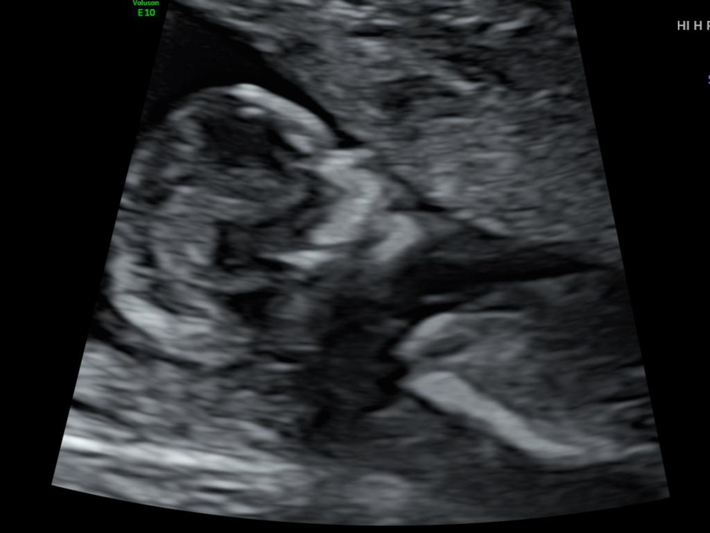 Not just a white blob anymore! The baby’s side profile in the 12-week ultrasound.