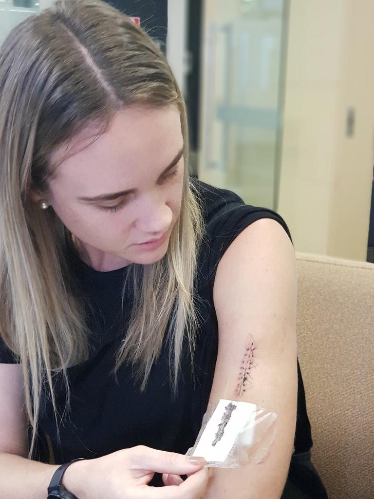She had to undergo two procedures to have it cut out from her left arm and its surrounds to prevent it from spreading. Picture: Jade Offord