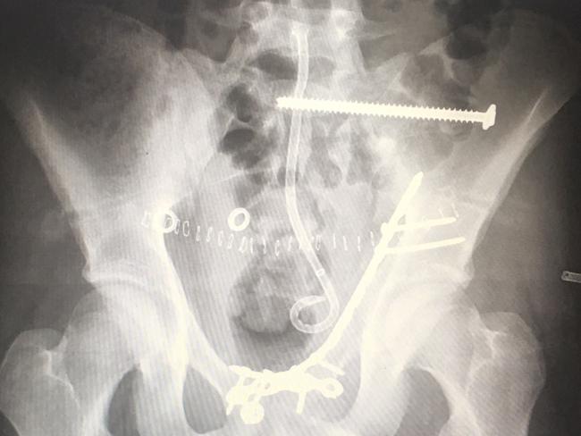 Josh’s pelvis sheared in two as a result of the crash.