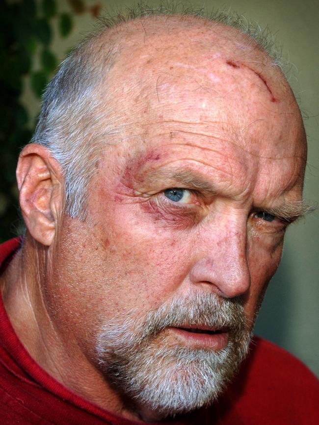 Rex Hunt after being attacked in Byron Bay in 2005.